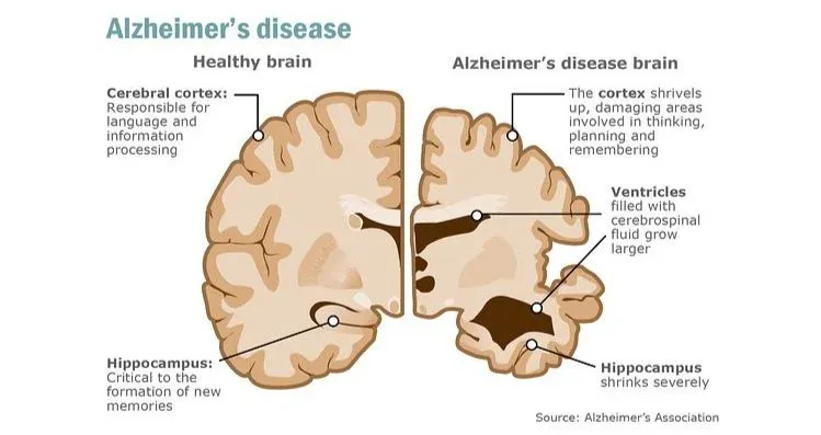 Diagram of the difference between a healthy brain and a brain affected by Alzheimer's disease