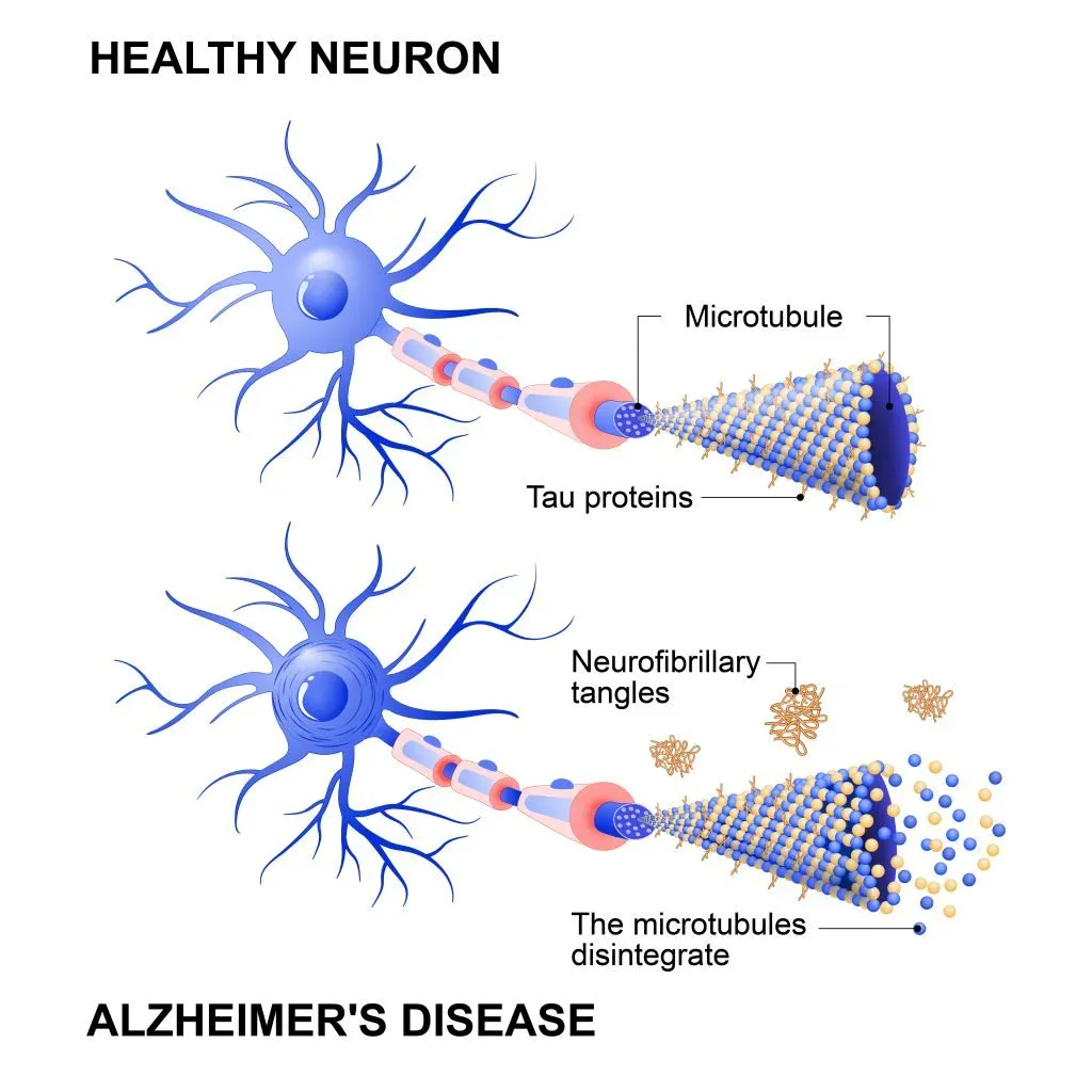 healthy neuron vs a neuron affected by alzheimer's disease diagram